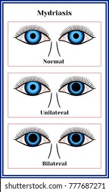 Mydriasis - Expansion Of A Pupil.