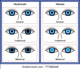 dilated pupils vs normal