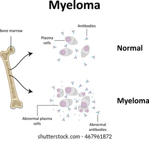 Myeloma Illustration