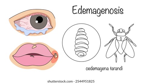 Miíase causada por parasitismo por larvas de borboleta. Em humanos, a edemagenose manifesta-se como edema, conjuntivite e um tumor no canto da boca, a partir do qual se vê a larva. Vetor.