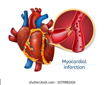 Myocardial Infarction. 3d Realostic Illustration Of Human Heart With Blocked Coronary Artery. Vector Plaque Heart Attack