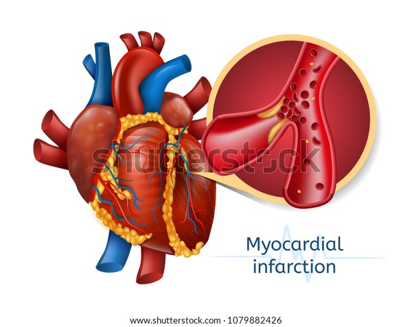 心筋梗塞 冠 状 動脈が閉塞した人の心臓の3dイラスト ベクタープラーク心臓発作 のベクター画像素材 ロイヤリティフリー