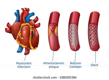 Myocardial Infarction. 3d Realostic Stent In Illustration Of Human Heart With Blocked Coronary Artery. Vector Plaque Heart Attack. Angioplasty.