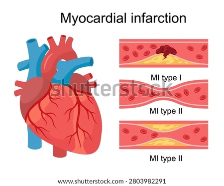 Myocardial Infarction Classification Vector Diagram, Human Heart Anatomy and Blood Vessel Cross Section Illustration, Heart Attack Mechanisms showing MI Type I and MI Type II, Cardiology Medical Infographic