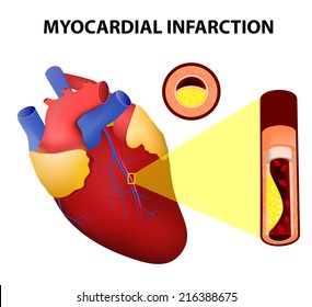 Myocardial Infarction Or Heart Attack