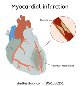 Myocardial Infarction Heart Attack Blocked Artery Stock Vector (Royalty ...