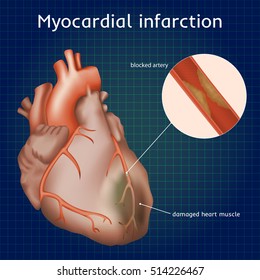 Myocardial infarction. Heart attack. Blocked artery, damaged heart muscle. Anatomy illustration. Red image, dark blue science background.