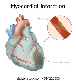 Myocardial infarction. Heart attack. Blocked artery, damaged heart muscle. Anatomy illustration. Colorful image, white background.