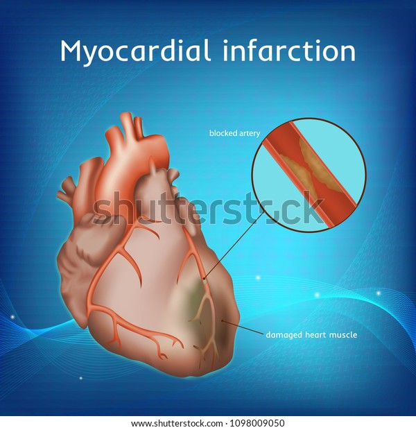 Myocardial Infarction Heart Attack Blocked Artery Stock Vector Royalty