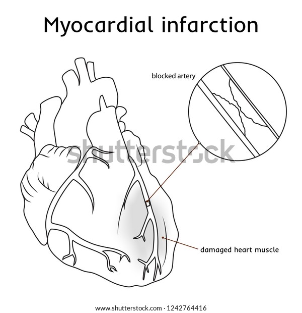 Myocardial Infarction Heart Attack Blocked Artery Stock Vector Royalty