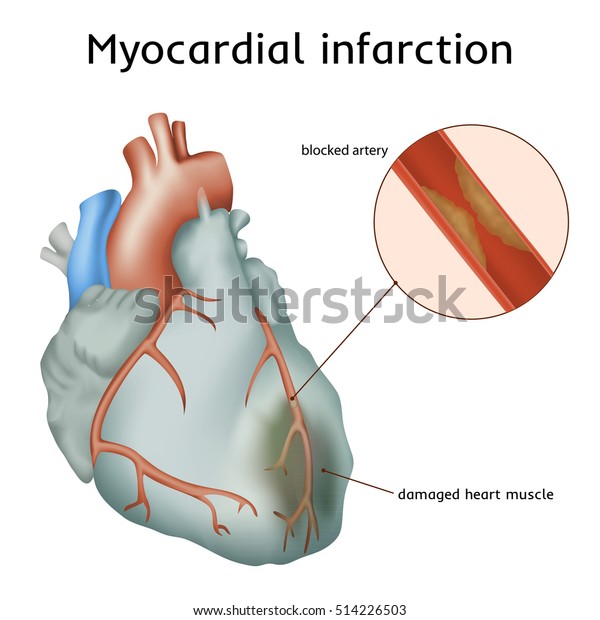 Myocardial Infarction Heart Attack Blocked Artery Stock Vector (Royalty ...