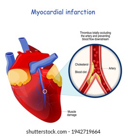 Myocardial Infarction. Heart Attack.  Heart With Muscle Damage. Artery With Cholesterol (atherosclerotic Plaque) And Blood Clot. Vector Illustration