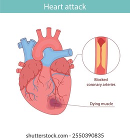 Myocardial infarction. Illustration of a human heart. Heart attack. Illustration in cartoon style