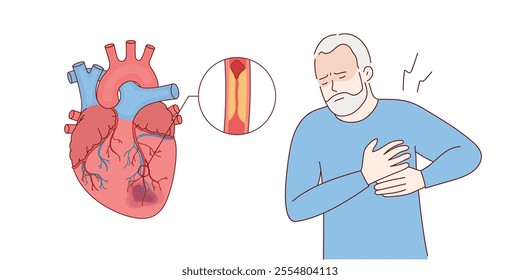 Myocardial infarction. Illustration of a human heart. Heart attack. Illustration in cartoon style