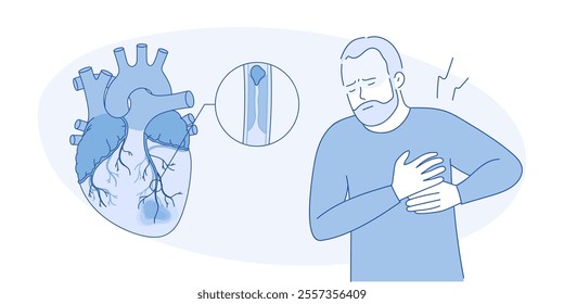 Myocardial infarction. Illustration of a human heart. Heart attack. Illustration in cartoon style