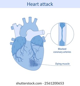 Myocardial infarction. Illustration of a human heart. Heart attack. Illustration in cartoon style