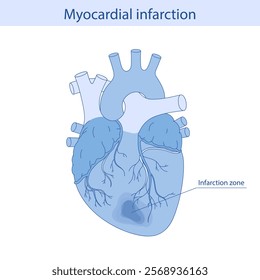 Myocardial infarction. Illustration of a human heart. Heart attack. Illustration in cartoon style