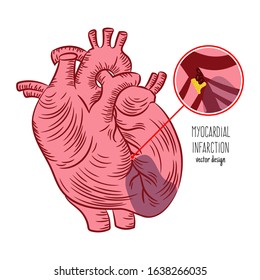 MYOCARDIAL INFARCTION SCHEME Heart Attack Medicine Education