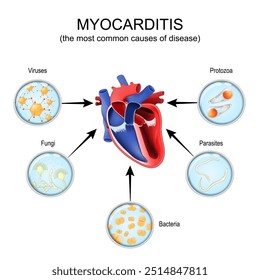 Myocarditis. Cross section of a human heart and the most common causes of disease like Protozoa, Bacteria, Parasites, Fungi, Viruses. Vector illustration. Schematic diagram. Detailed poster.