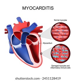 Miocarditis. Cardiomiopatía inflamatoria. Sección transversal de un corazón humano y el miocardio. Primer plano de un miocito normal, miocitos dañados y células inmunitarias inflamatorias. Ilustración vectorial