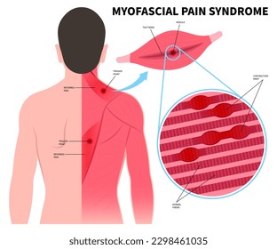 Myofascial Pain Syndrome muscle trauma anatomy Trigger Point office Fibromyalgia Gluteus Medius strain calf hip knee arm or Capitis Fascia Shock Wave fibers shots of Taut Band spasm Sport relieve