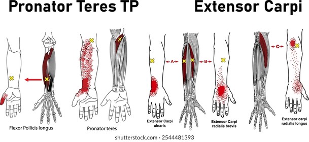 Ponto de desencadeamento miofascial, Pronator Teres TP, Carpo extensor