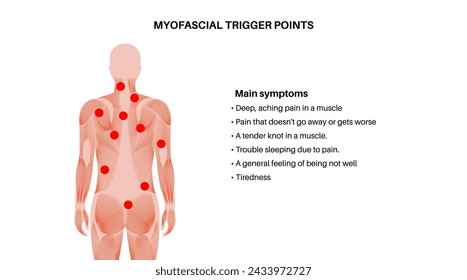 Afiche médico de puntos gatillo miofascial. Concepto de MTrPs. Manchas hiperirritables en los nudos del músculo esquelético en la silueta masculina. Puntos rojos en áreas sensibles en el cuerpo humano ilustración vectorial plana