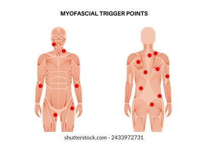 Myofascial trigger points medical poster. MTrPs concept. Hyperirritable spots in the skeletal muscle knots in male silhouette. Red points in sensitive areas on the human body flat vector illustration