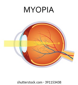 Myopia is being short sighted. Far away object seems blurry. Detailed anatomy of the eye.