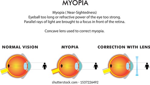Myopia Power Chart
