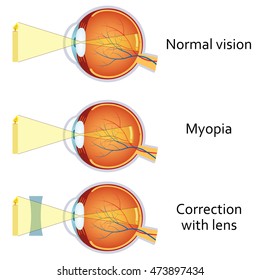 Myopia vs. Hyperopia