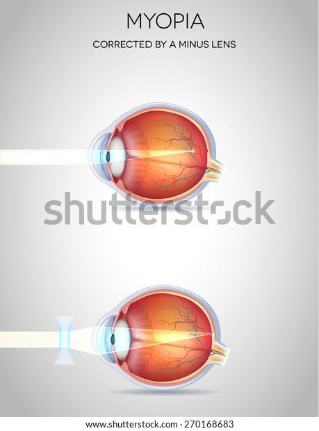 Myopia Myopia Corrected By Minus Lens Stock Vector (Royalty Free ...