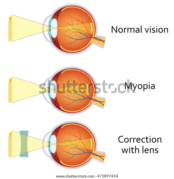 torna myopia myopia-val bélbetegség és látás