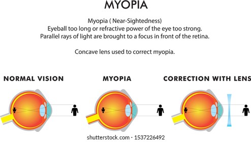 Myopia in eye disorders vector illustration