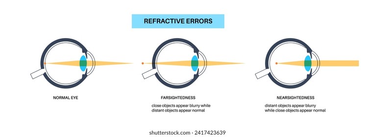 Myopia and hyperopia eye disease anatomical poster. Nearsightedness and farsightedness concept. Short sightedness, long sightedness vision disorder. Refractive errors medical flat vector illustration