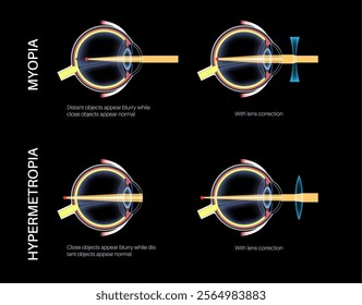 Myopia and hyperopia eye disease correction with lens. Nearsightedness and farsightedness treatment. Short sightedness, long sightedness vision disorder. Refractive errors medical vector illustration