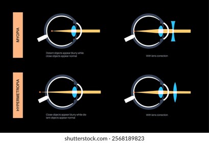 Myopia and hyperopia eye disease correction with lens. Nearsightedness and farsightedness treatment. Short sightedness, long sightedness vision disorder. Refractive errors medical vector illustration