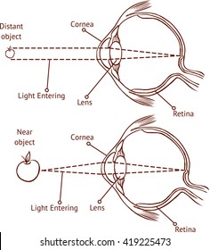Myopia and normal vision ( color vector illustration )