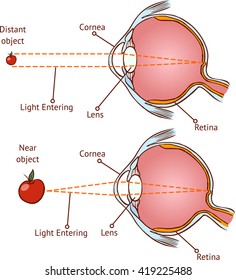 Myopia and normal vision ( color vector illustration )