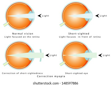 Myopia. Normal vision, light focused on the retina. Short - sighted, light focused in front of retina, so the eye interprets a blurred image. Correction of myopia. Correction of short - sightedness