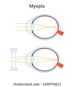 Myopia, short sightedness or near sightedness eye disorder and  corrected eye by a minus lens or biconcave negative lens. The light is focused in front of the retina. Illustration is isolated on white