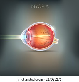 Myopia, vision disorder being short sighted. Far away object seems blurry. 