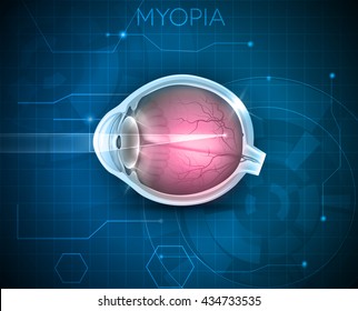 Myopia, vision disorder on a blue technology background. Being short sighted (near sighted), far away object seems blurry. 