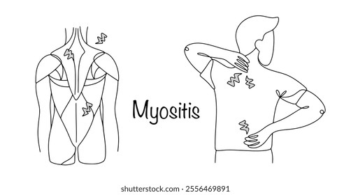 Myositis. Inflammation of the muscles of the musculoskeletal system. Drawn main points where myositis occurs. Human muscles and a man experiencing back pain. Vector illustration.