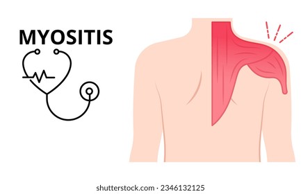 Myositis text on medical background with illustration character Concept of human disease