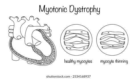 Myotonic Dystrophy. Non-inflammatory damage to the heart muscle, in which myocytes become thinner. A drawn heart with the myocardium highlighted, as well as healthy and deformed myocytes. Vector.