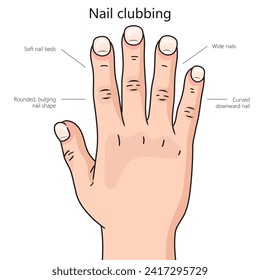 Nail clubbing diagram hand drawn schematic vector illustration. Medical science educational illustration