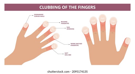 Nail clubbing. Symptoms tetralogy of Fallot bone swelling warning sign toenails coughing enlarged cyanosis late fingertips problem liver toe skin watch glass ild ipf pain copd