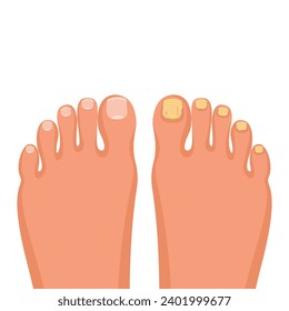 Nail disease. Onychomycosis concept. Fungal nail infection. Paronychia is inflammation of the skin around the toenail. Fungal disease, psoriasis. Vector illustration flat design. 