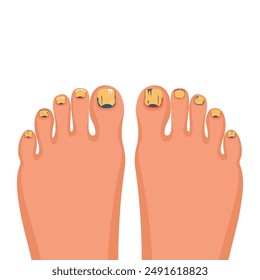 Nail disease. Onychomycosis concept. Fungal nail infection. Paronychia is inflammation of the skin around the toenail. Fungal disease, psoriasis. Vector illustration flat design. 